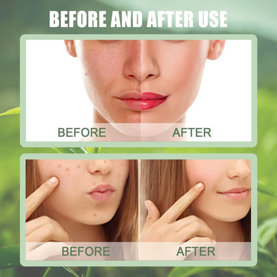 BIOSKIN™ - Natural Green Tea Mask